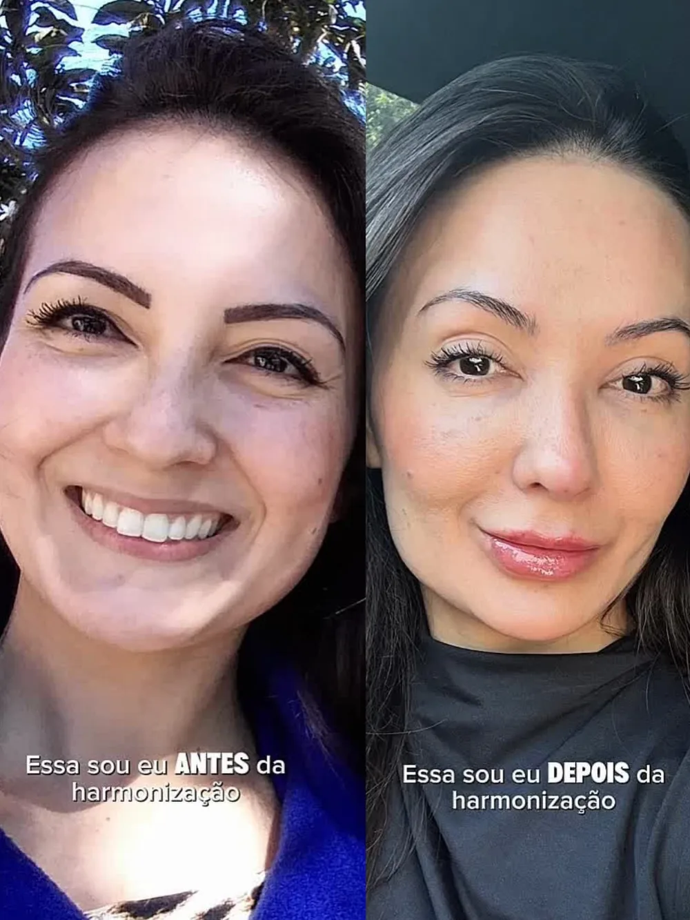 Dra. Fabiana Yokota antes e depois da própria harmonização