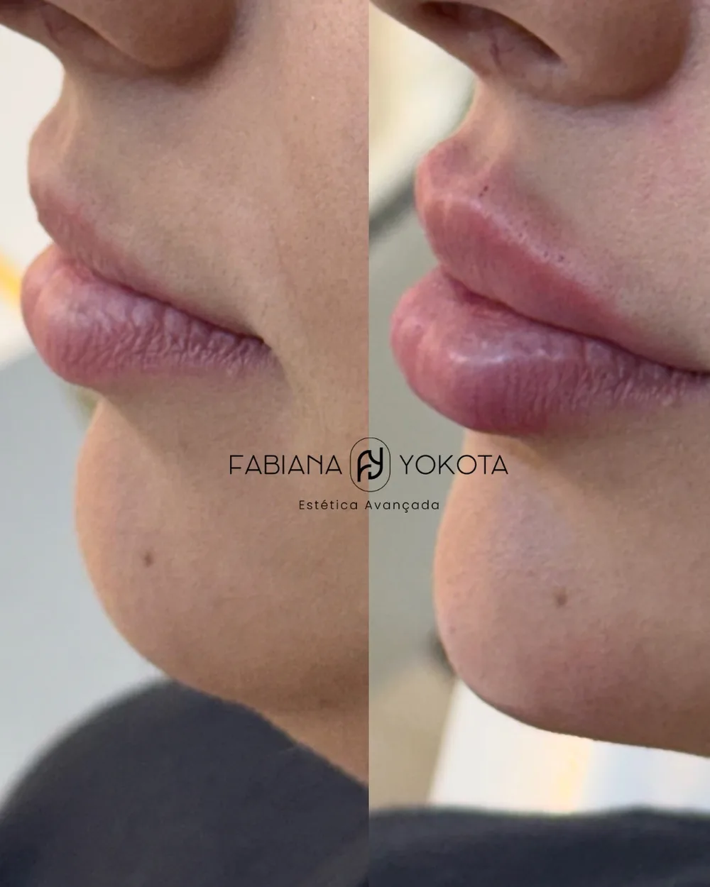 Antes e depois de preenchimento de lábios e mento