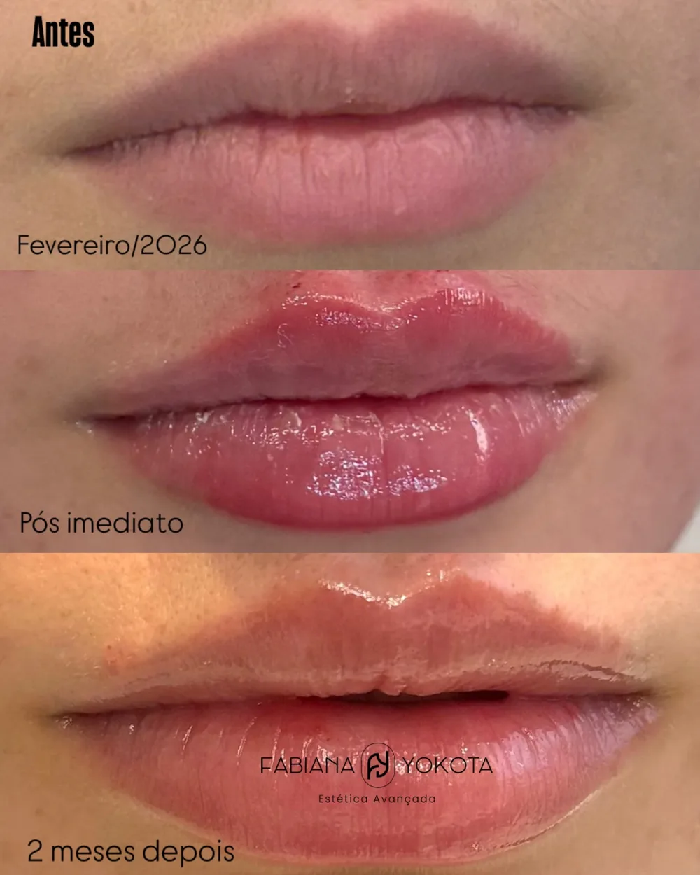 Evolução de preenchimento labial: antes, pós imediato e dois meses depois