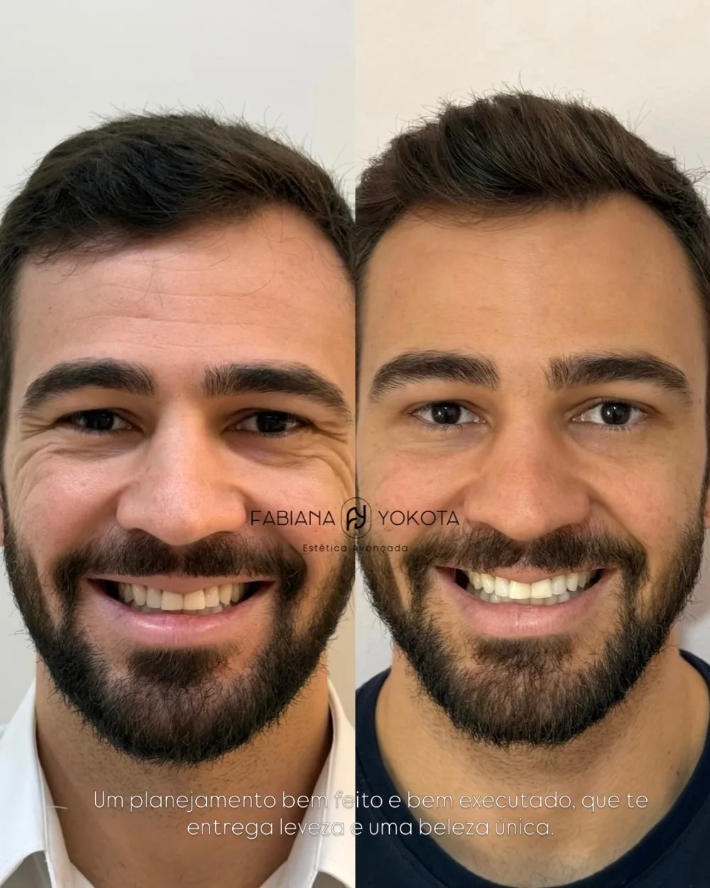Antes e depois de harmonização facial masculina